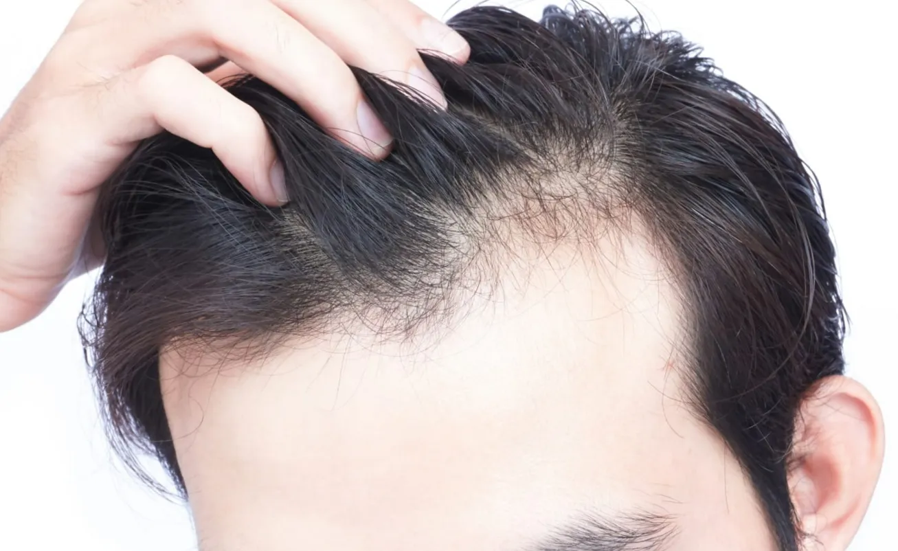 hair loss remedies