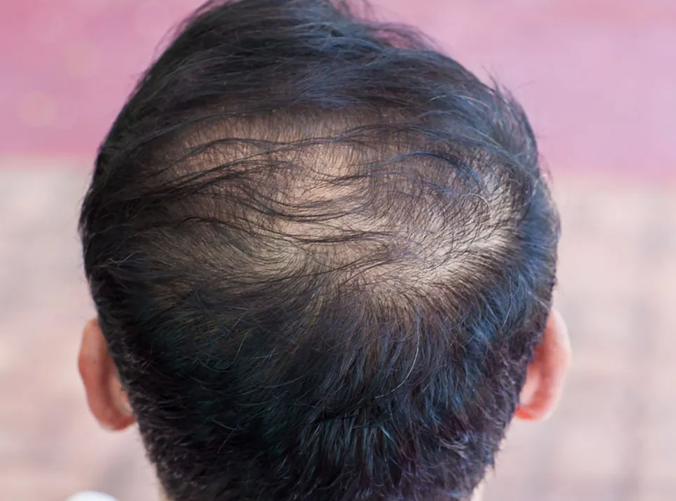 halting hair loss